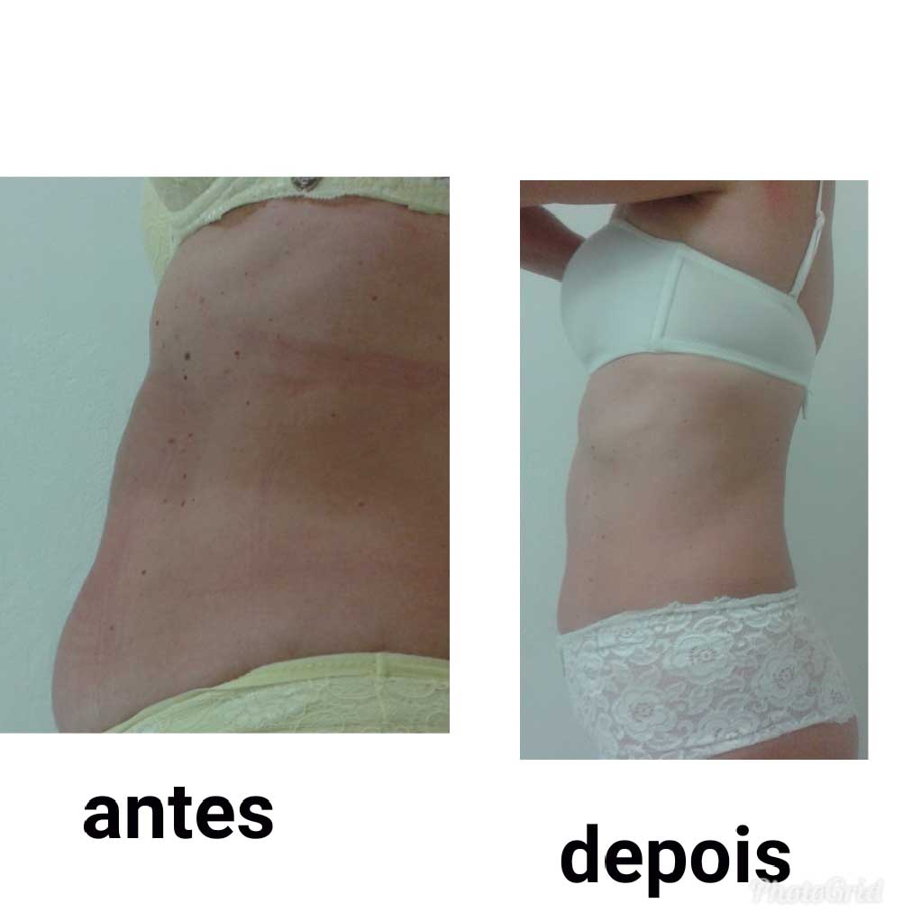 Antes E Depois Milena Della Testa