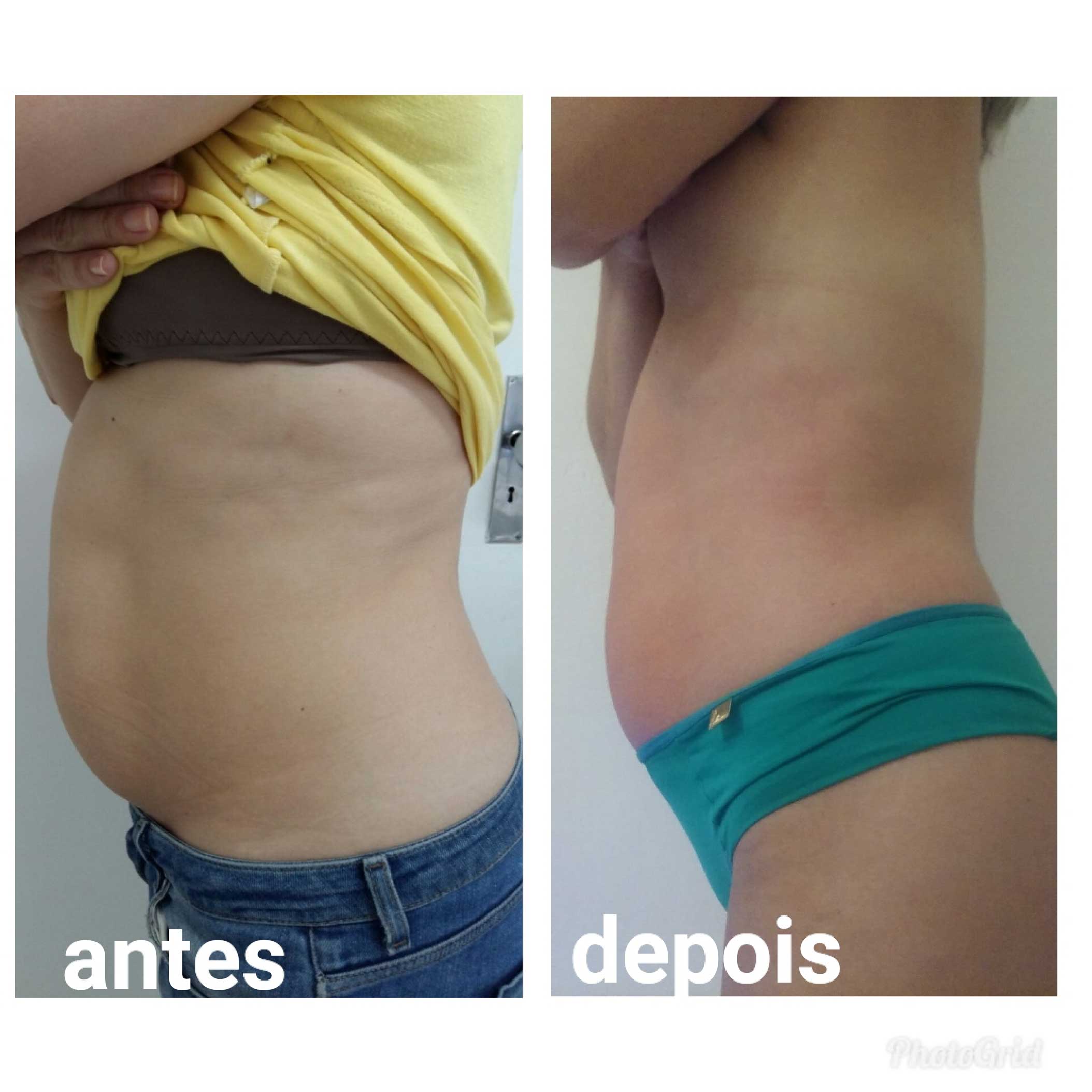 Antes E Depois Milena Della Testa